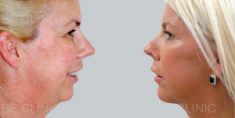 Facelift - Photo before - Be Clinic