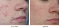 Laser acne treatment - Photo before - Laserová dermatologická klinika ALTOS