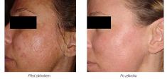 Chemical peeling - Photo before - Laserová dermatologická klinika ALTOS