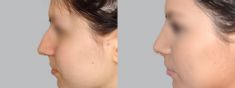 Rhinoplasty (Nose Job) - Photo before - Asklepion – Laser and Aesthetic medicine