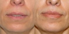Lip augmentation - cheiloplasty - Photo before - Mr. Christopher Inglefield BSc, MBBS, FRCS(Plast)
