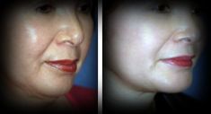 Chin Surgery - Photo before - Mandala Beauty Clinic