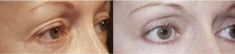 Eyelid surgery (Blepharoplasty) - Photo before - Mandala Beauty Clinic
