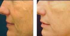 Radiofrequency Rejuvenation (Aluma, accent, TriPollar, Spa RF device, Re-Age) - Photo before