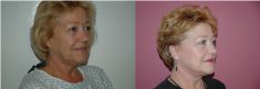 Facelift - Photo before - McIndoe Cosmetic Surgery