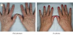 Age Spots Treatment - Photo before - Laserová dermatologická klinika ALTOS