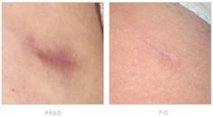 Laser Scar Treatment - Photo before