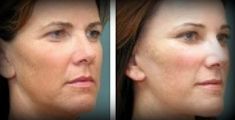 Facelift - Photo before - Mandala Beauty Clinic