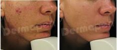 Mesotherapy (face, neck revitalization) - Photo before - Eveclinic Bratislava