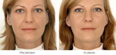 Botulinum toxin - Wrinkle Removal - Photo before - Laserová dermatologická klinika ALTOS