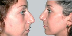 Rhinoplasty (Nose Job) - Photo before - Be Clinic