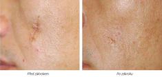 Laser Scar Treatment - Photo before - Laserová dermatologická klinika ALTOS