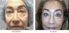 Eyelid surgery (Blepharoplasty) - Photo before - Laserová dermatologická klinika ALTOS