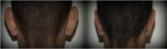 Ear surgery (Otoplasty) - Photo before - Mandala Beauty Clinic