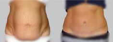 Abdominoplasty (Tummy Tucks) - Photo before - Asklepion – Laser and Aesthetic medicine