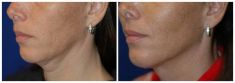 Ultrasonic liposuction - Photo before - Mandala Beauty Clinic