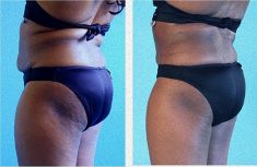 Liposuction - Photo before - Mandala Beauty Clinic