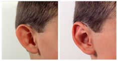 Ear surgery (Otoplasty) - Photo before - Mandala Beauty Clinic