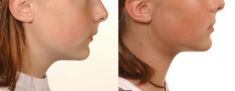 Other cosmetic and aesthetic dentistry - Photo before - McIndoe Cosmetic Surgery