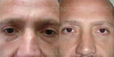 Eyelid surgery (Blepharoplasty) - Photo before - Be Clinic