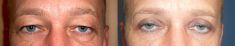 Eyelid surgery (Blepharoplasty) - Photo before - Be Clinic