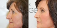 YES VISAGE Aesthetic medicine and plastic surgery clinic - Photo before - YES VISAGE Aesthetic medicine and plastic surgery clinic