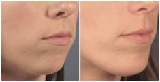 Chin Surgery - Photo before - Mandala Beauty Clinic