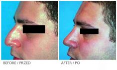 Rhinoplasty (Nose Job) - Photo before - Mandala Beauty Clinic
