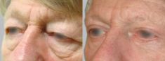 Asklepion – Laser and Aesthetic medicine - Photo before - Asklepion – Laser and Aesthetic medicine