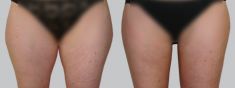 Liposuction - Photo before - Asklepion – Laser and Aesthetic medicine