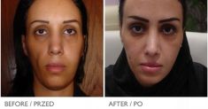 PRP – Plasma therapy - Photo before - Mandala Beauty Clinic