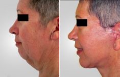Facelift - Photo before - Asklepion – Laser and Aesthetic medicine