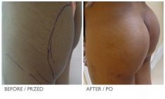 Enlargement and shaping of buttocks and hips - Photo before - Mandala Beauty Clinic