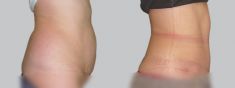 Abdominoplasty (Tummy Tucks) - Photo before - Asklepion – Laser and Aesthetic medicine