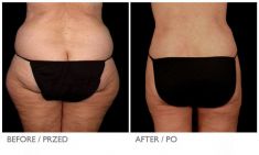 Ultrasonic liposuction - Photo before - Mandala Beauty Clinic
