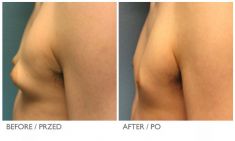 Gynecomastia (Male Breast Reduction) - Photo before - Mandala Beauty Clinic