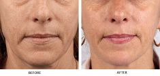 Dermal fillers - Photo before - Laserová dermatologická klinika ALTOS