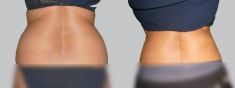 Liposuction - Photo before - Asklepion – Laser and Aesthetic medicine