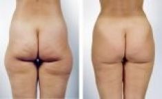 Tumescent liposuction - Photo before - Esthé a. s. - klinika plastické chirurgie