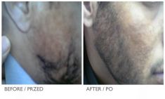 Hair Transplant - Photo before - Mandala Beauty Clinic