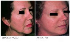 Facelift - Photo before - Mandala Beauty Clinic