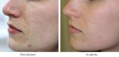 Laser acne treatment - Photo before - Laserová dermatologická klinika ALTOS