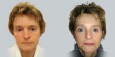 Facelift - Photo before - Be Clinic