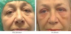 Eyelid surgery (Blepharoplasty) - Photo before - Laserová dermatologická klinika ALTOS