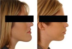 Chin Surgery - Photo before - McIndoe Cosmetic Surgery