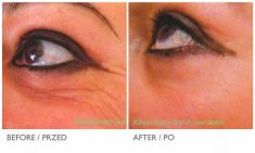 Botulinum toxin - Wrinkle Removal - Photo before - Mandala Beauty Clinic