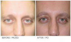 Eyebrow transplantation - Photo before - Mandala Beauty Clinic