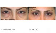 Eyelid surgery (Blepharoplasty) - Photo before - Mandala Beauty Clinic