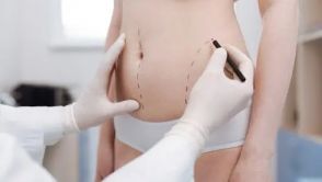 Mommy makeover: the new trend in plastic surgery