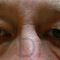 Eyelid surgery (Blepharoplasty)
